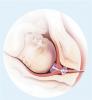 cervical_ripening_balon.jpg